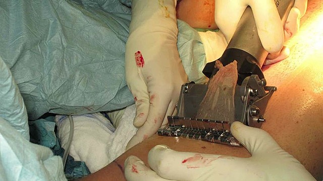 Primer injerto de piel humano.