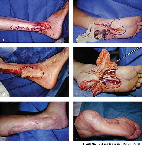 Colgajo de Extremidad inferior