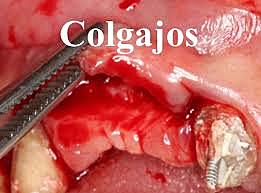 Triangulo reconstructivo.