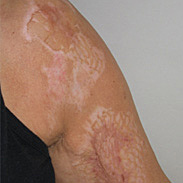 Emplastos de plantas