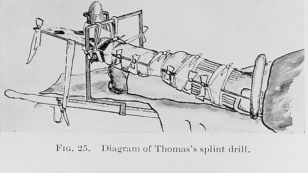 La férula de Thomas