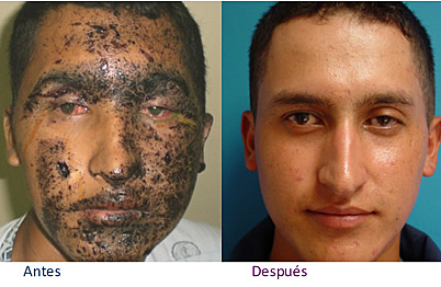 Dermoabrasion Quimica.