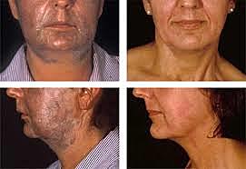 Primer Referencia de la Dermoabrasion.