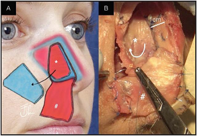Plegamiento del colgajo.