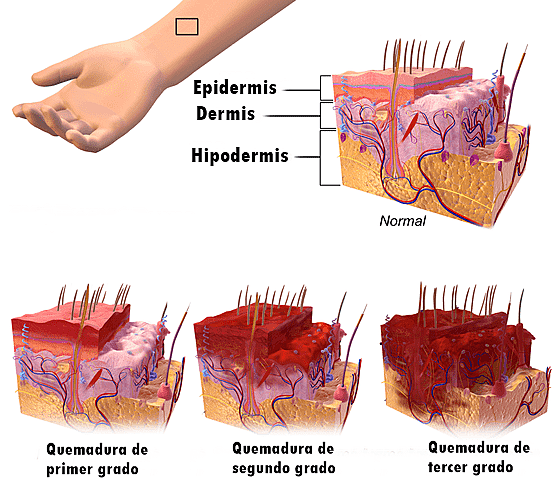 Grados de las quemaduras.