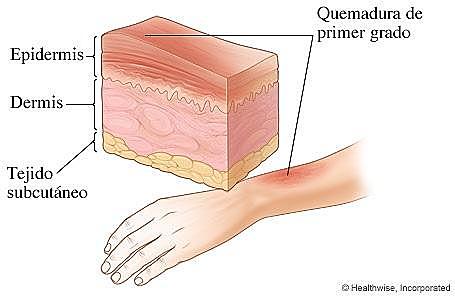 Quemadura de primer grado.
