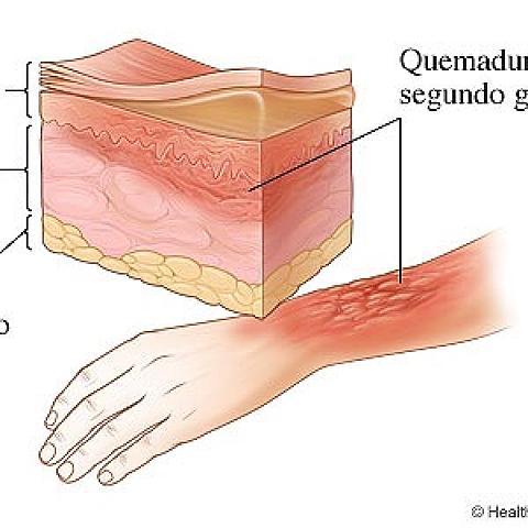 Quemadura de Segundo grado.