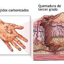 Quemadura de tercer grado.