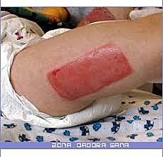 ¿Como se realiza una Cx para poner un injerto?