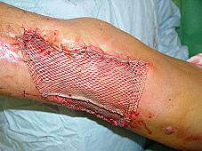 Indicaciones para realizar un injerto.