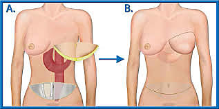 Según método de transferencia.