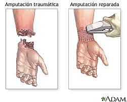 AMPUTACIONES
