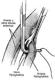 Ligadura en Amputaciones
