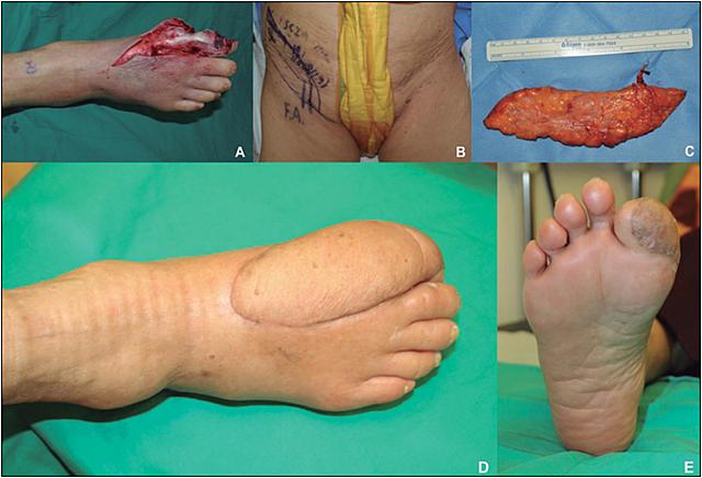 Amputaciones y colgajos.