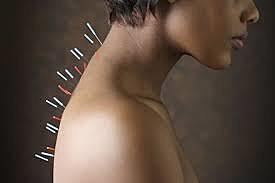 Medicina Alternativa: Acupuntura