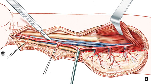 Colgajos pediculados