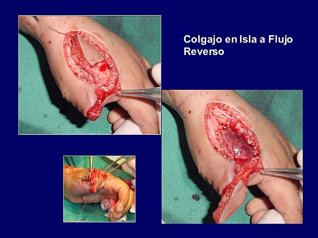 Colgajos musculares en Isla