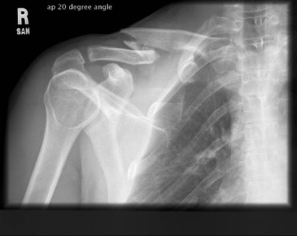 i broke my first bone