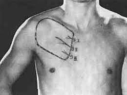 Colgajos más extensos