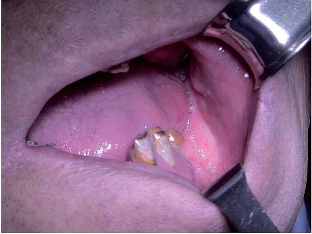 Colgajo compuesto de cresta iliaca