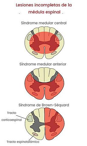 Descripción del Síndrome de Brown-Sequard