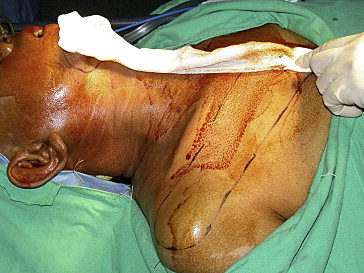 Colgajo deltopectoral