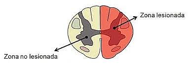 Hemisección medular triada