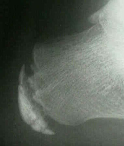 At one year old I broke my gowth plate in my heel