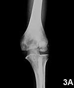 Karter broke his bone