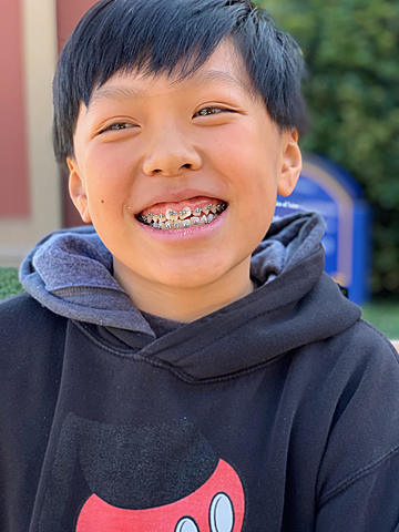 When I first got my braces