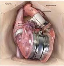 Corazon artificial AbioCor