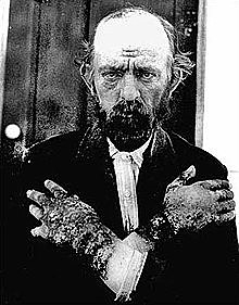 PELAGRA EN DOCE INTERNOS