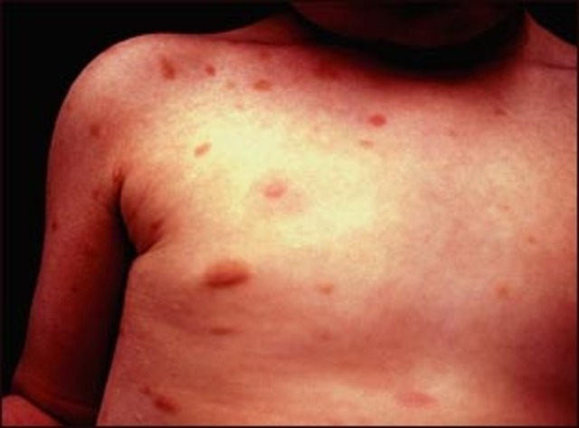 I was diagnosed with Urticaria Pigmentosa.