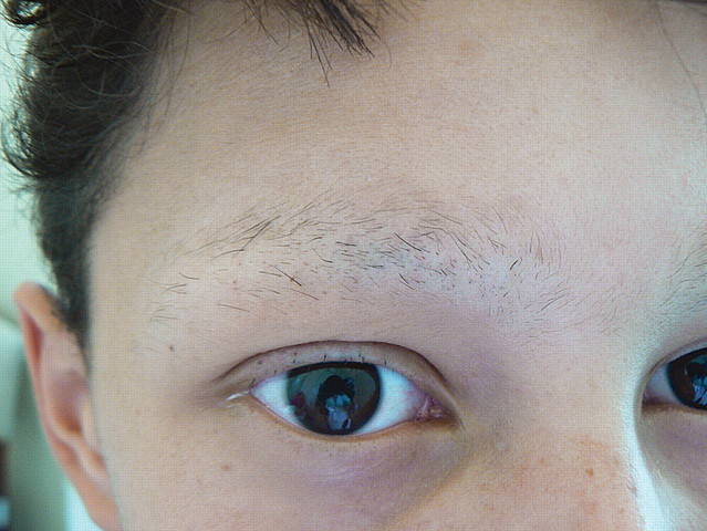 diagnoised with TTM, Anxiety, and Depression