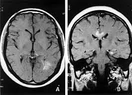 Opinión publica del TAC