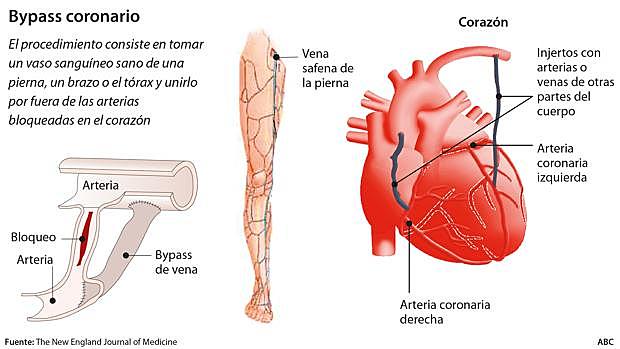 BYPASS CORONARIO