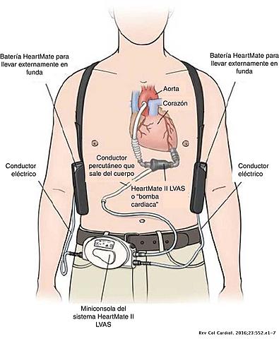DISPOSITIVO DE ASISTENCIA VENTRICULAR