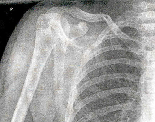 fractured my clavical