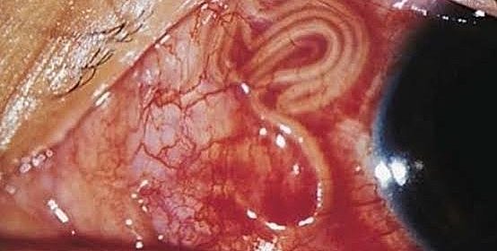 Lanzamiento del Programa de Lucha contra la Oncocercosis