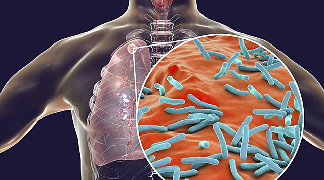 Lanzamiento de la estrategia DOTS