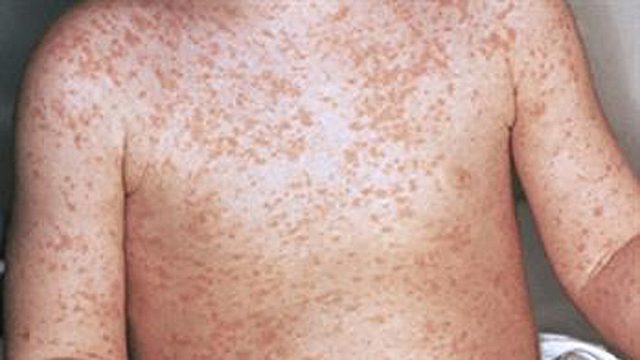 Lanzamiento de la Iniciativa de Lucha contra el Sarampión