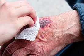 Servicio de atencion a quemados