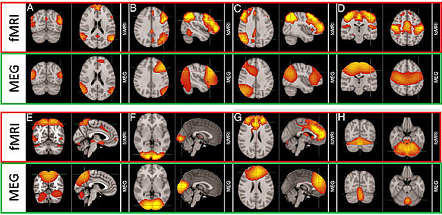Magnetoencefalografía (MEG)