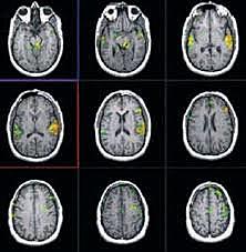 Resonancia funcional magnética