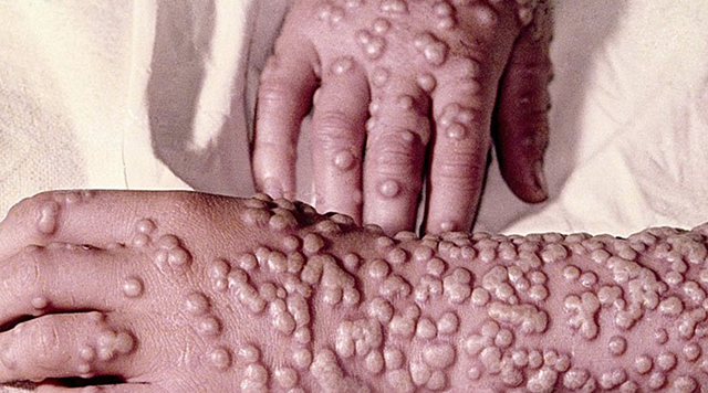 Smallpox Epidemic of 1721
