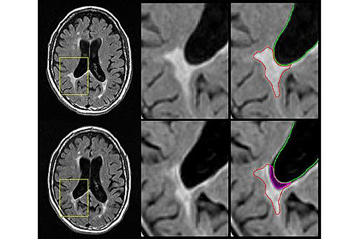 Lesiones Corteza Cerebral