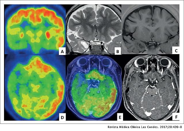 Identificación de Focos Epilépticos o Tumorales