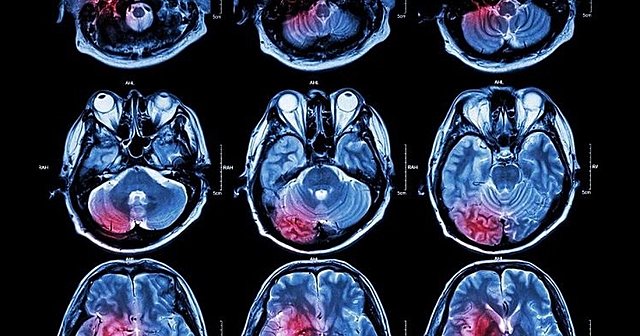 PERIODO CONTEMPORANEO - 1975 la neuropsicología ha tenido un crecimiento notorio.