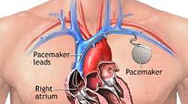 Timeline: The making of the pacemaker