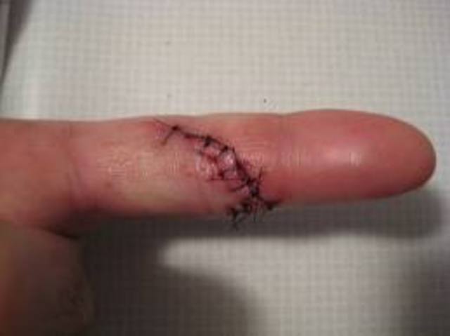 First Stitches